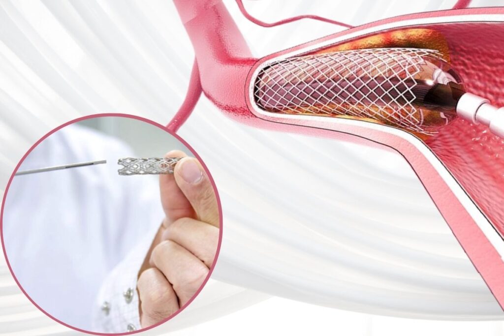 heart stent price