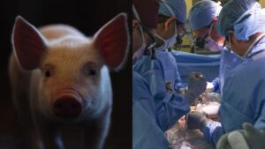 pig kidney transplant xenotransplantation